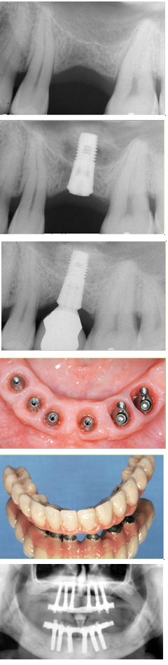 Implantologo a Pisa Implantologia, Impianti dentali titanio